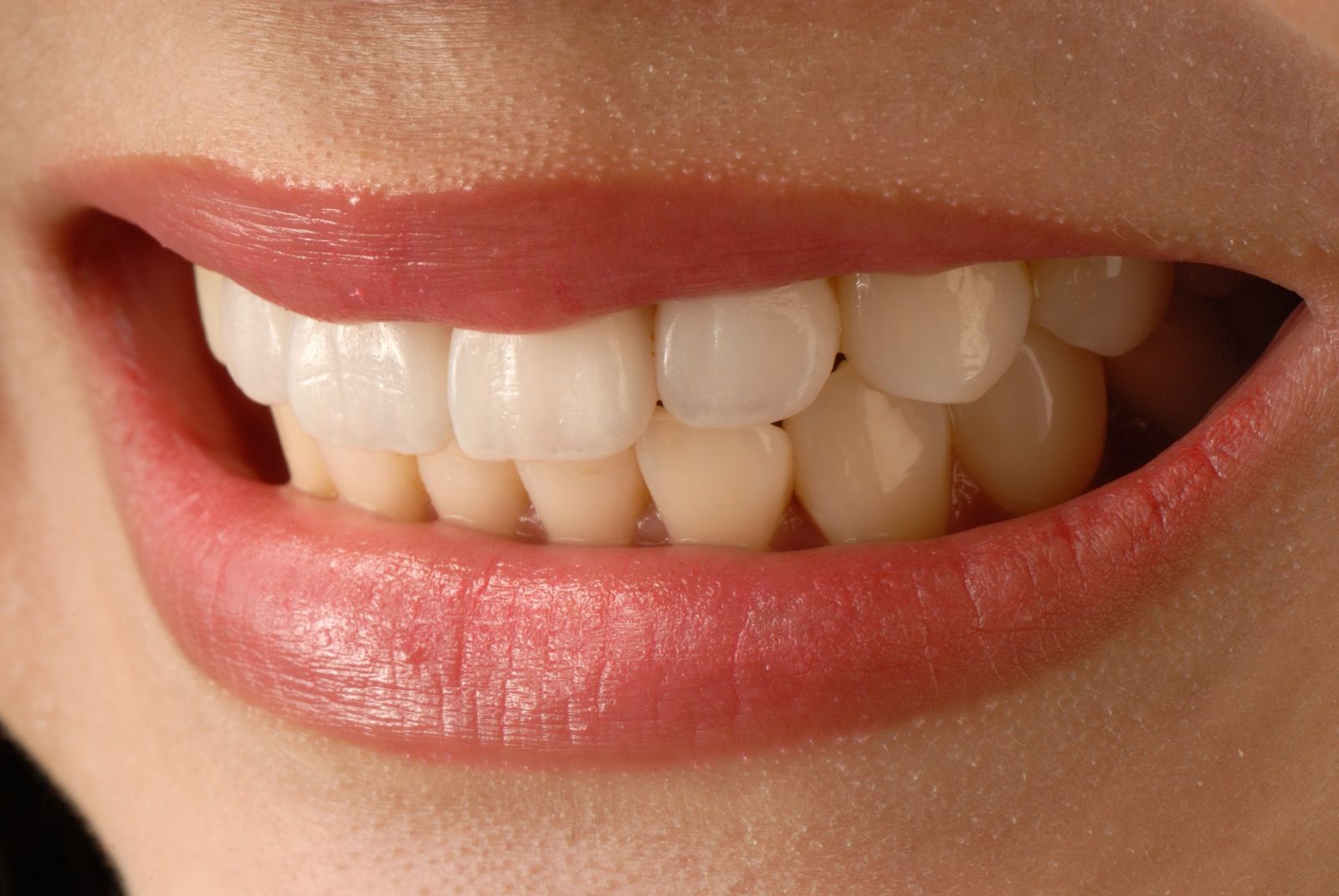 beautiful smile due to dental bridges