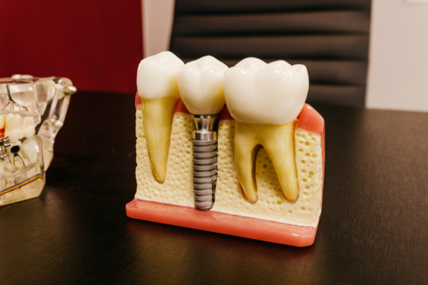 dental implant mock-up