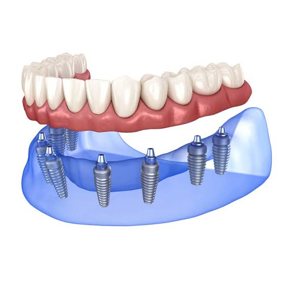 Full arch smile restoration