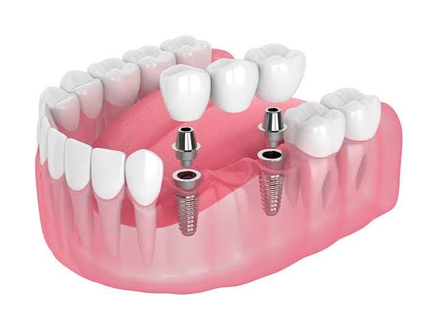 Multiple teeth implant bridge model