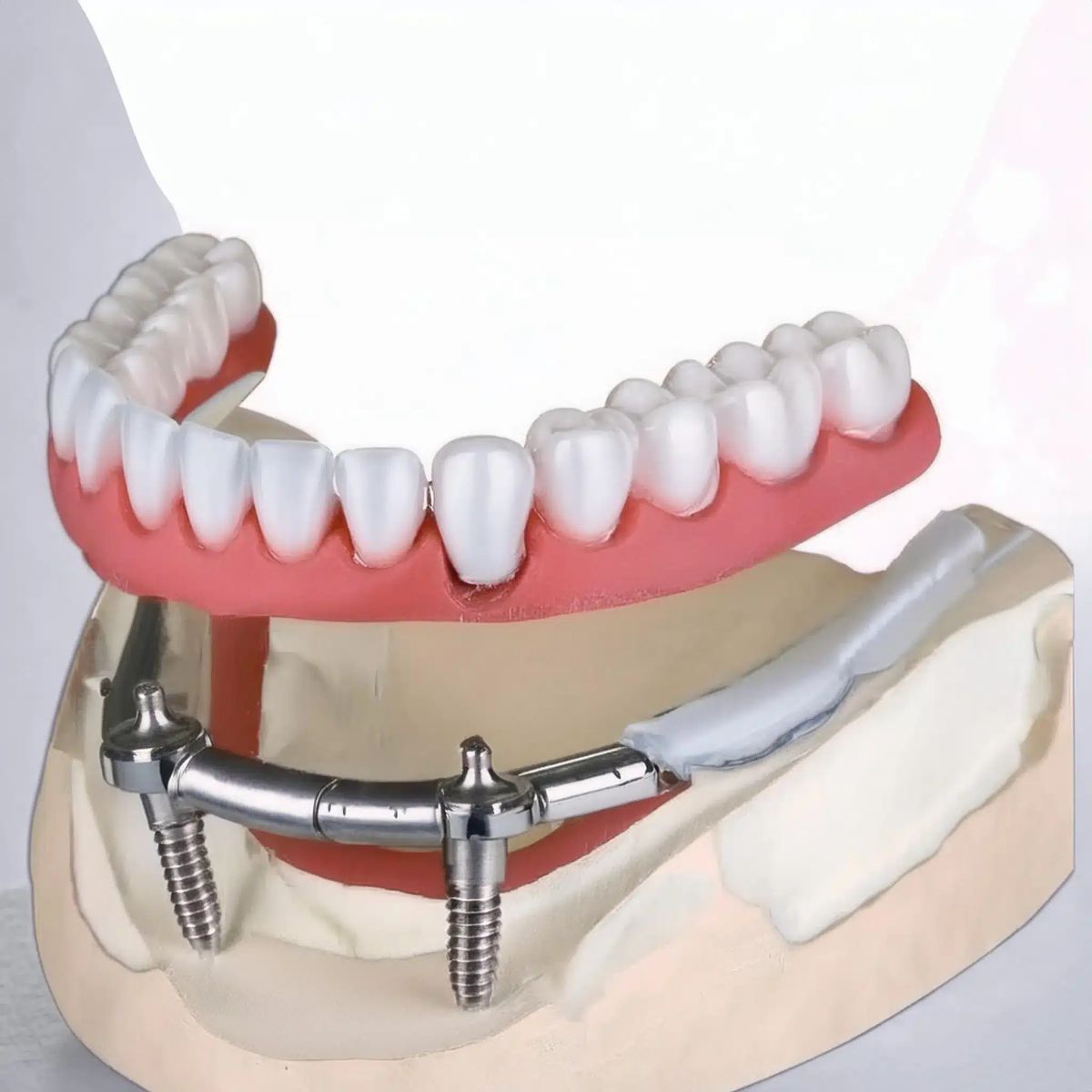 Overdenture confident healthy smile