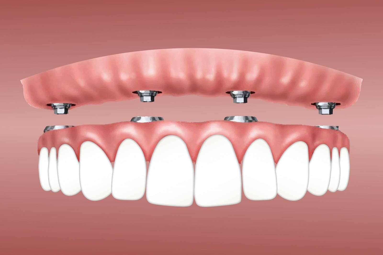 Overdenture implant 